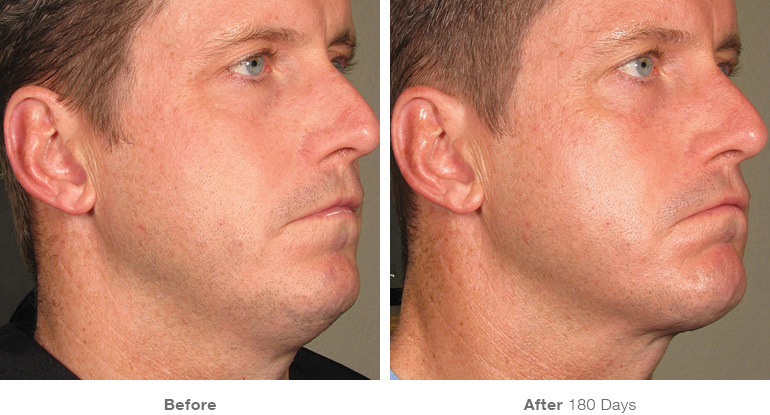 Ultherapy before and after