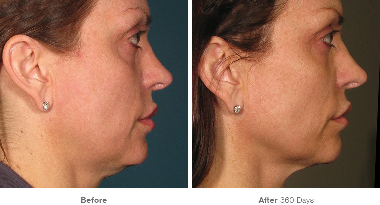 Ultherapy before and after