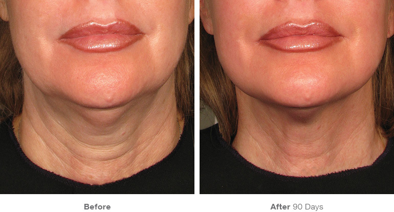 Ultherapy before and after