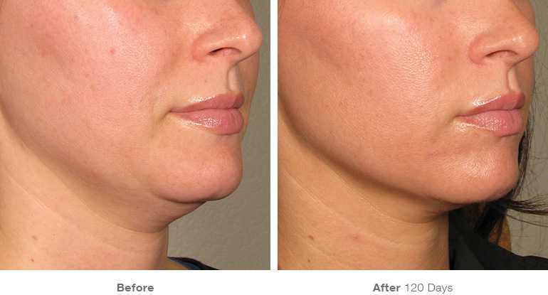 Ultherapy before and after